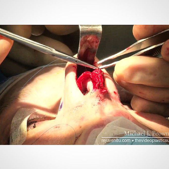 Rhinoplasty - Nose reshaping