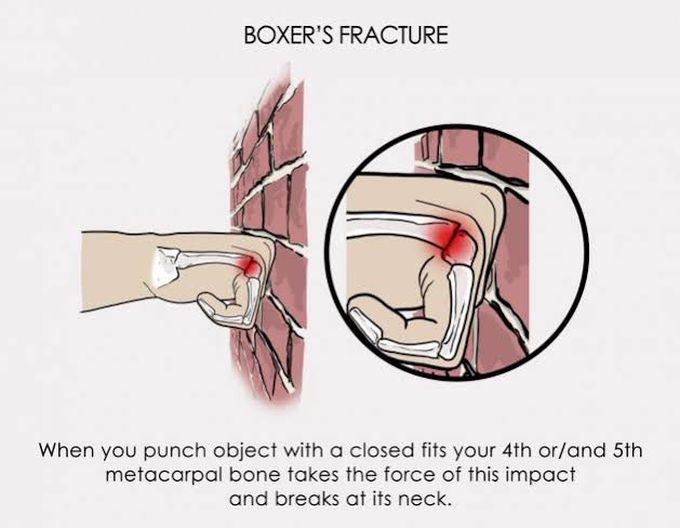 Boxer's fracture