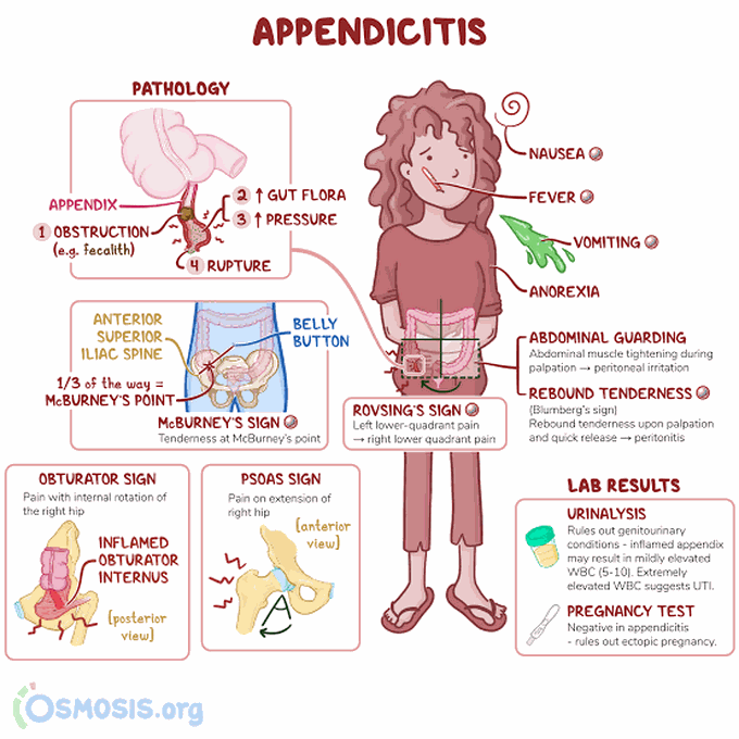 Appendicitis