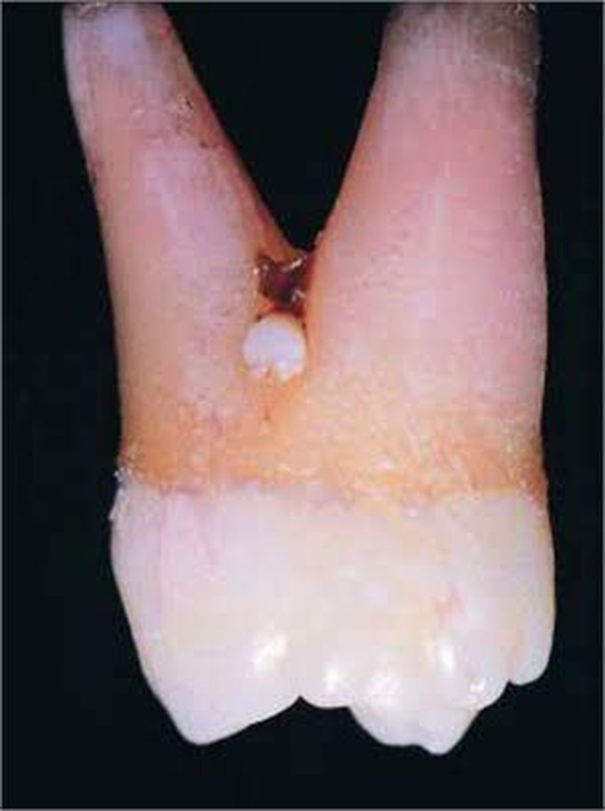 causes of enamel pearls