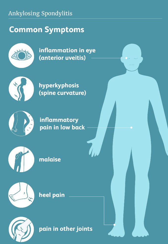 Symptoms of Ankylosing spondylitis