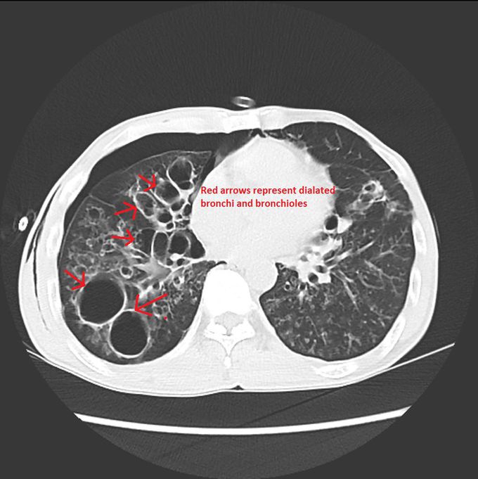 CT Findings in Bronchiectasis