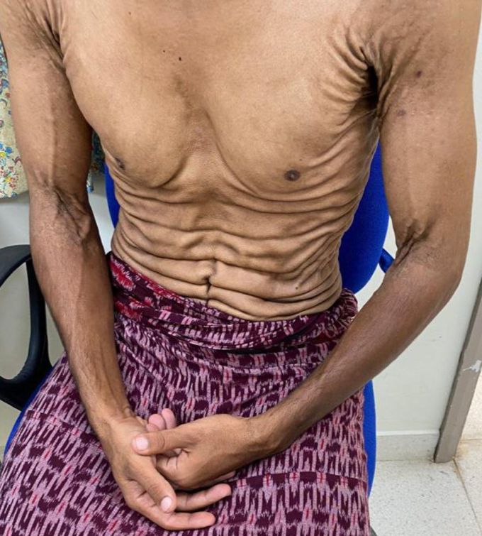 Bleeding Disorder And Saggy Skin