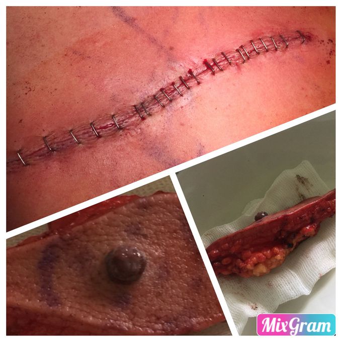 Excision about melanoma