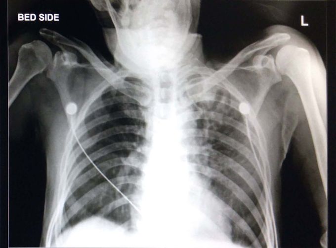 Chest X-ray