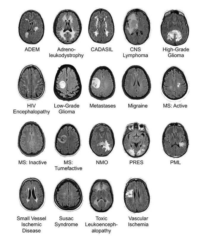 Brain lesions on FLAIR MRI