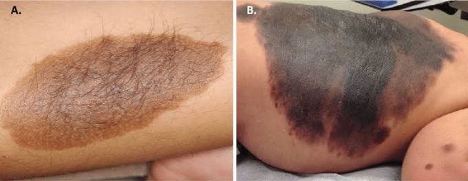 congenital melanotic nevi Congenital melanocytic nevus