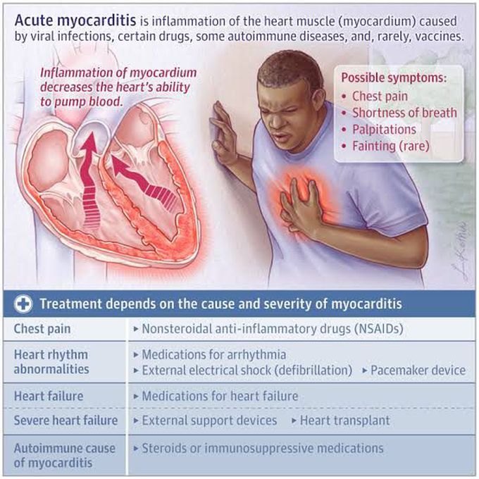 Acute Myocarditis