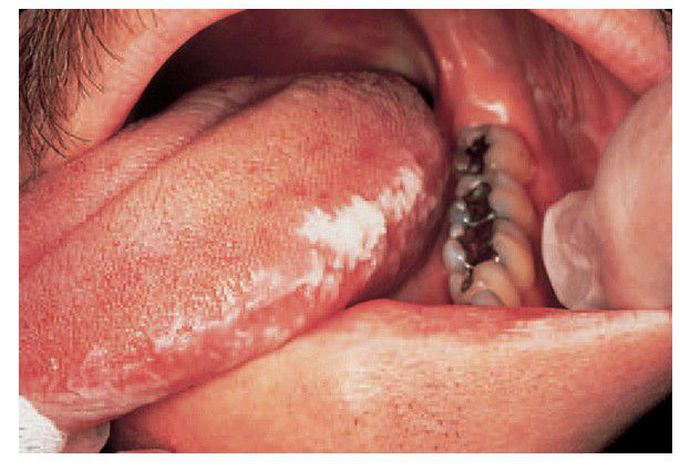 Hairy leukoplakia