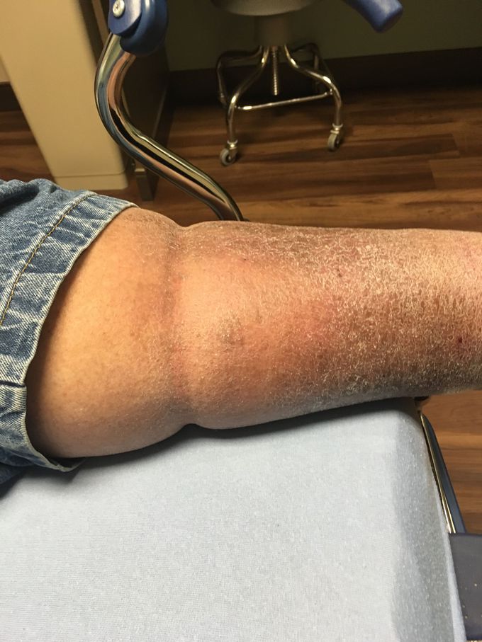 Cellulitis