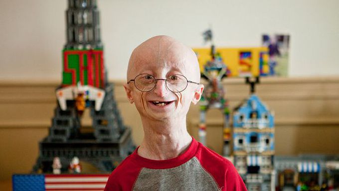 # Progeria