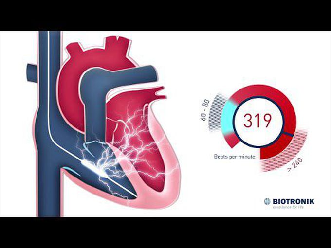 Implantable Cardioverter Defibrillator-
animation