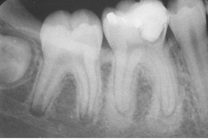 Condensing Osteitis.