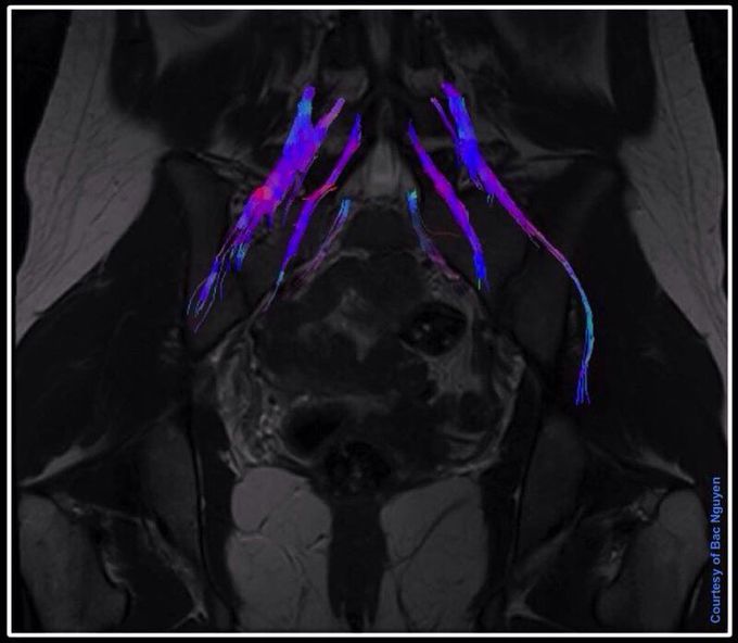 MR Neurography of lumbosacral plexus