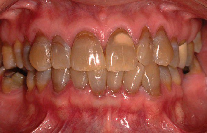 Tetracycline related discolouration