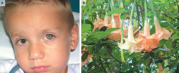 Mydriasis in the Garden