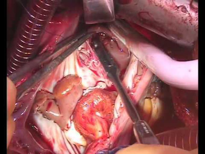 Tricuspid Valve Replacement with a Mitral Homograft for Destructive Endocarditis