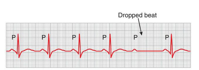 Second degree heart block