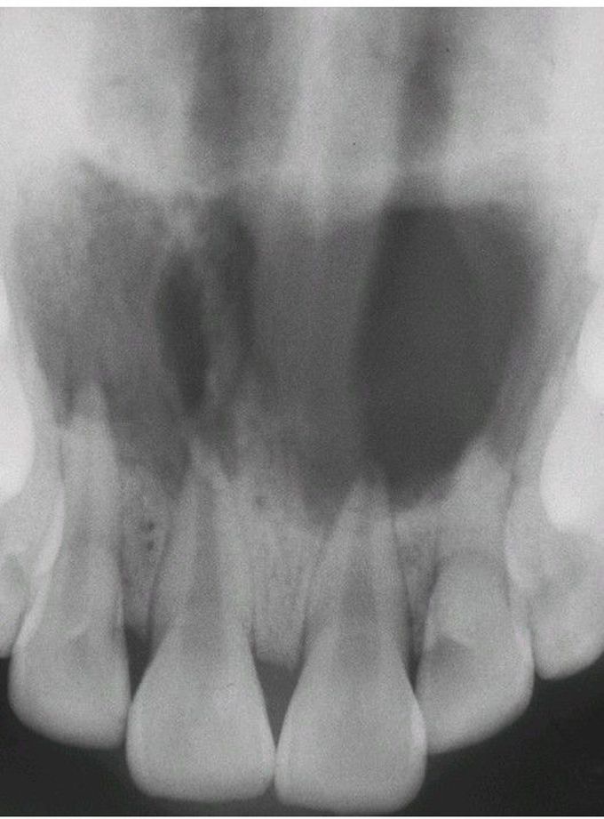 Periapical Abscess