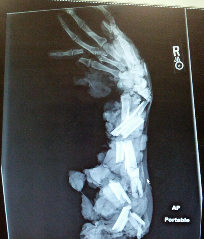 X-ray of a meat grinder injury to the arm and hand