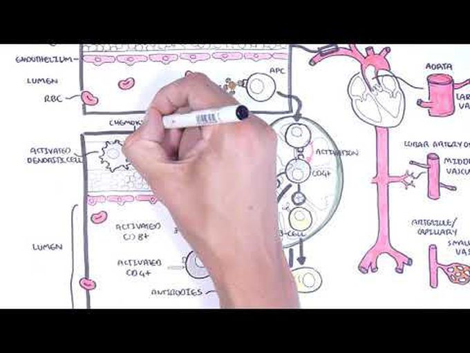 Vasculitis Pathophysiology Overview