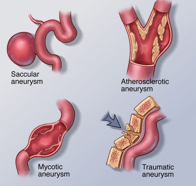 Different cerebral aneurysms