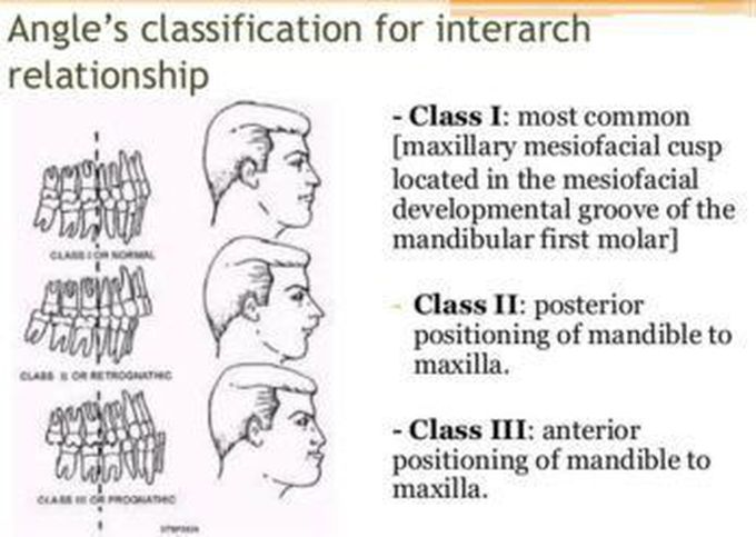 Angle's classification of Malocclusion