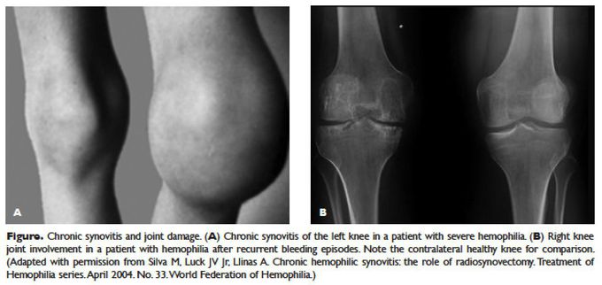 Hemophilia A