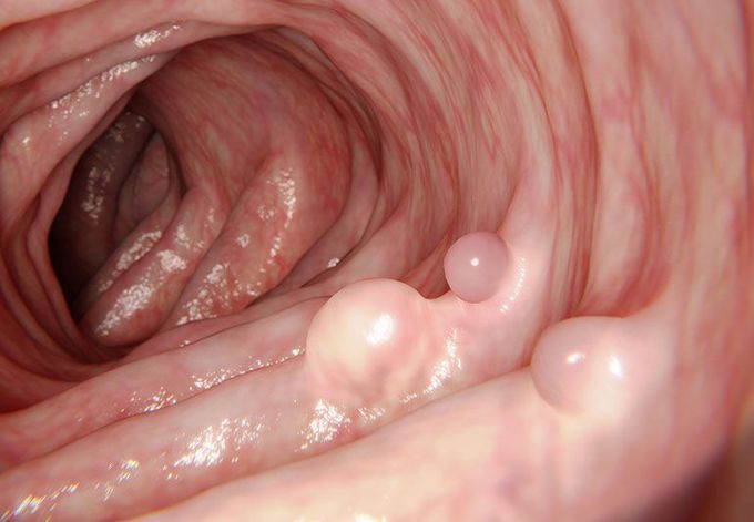Cause of Colonic polyps