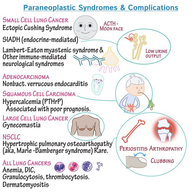 Paraneoplastic syndromes associated with Lung carcinomas.