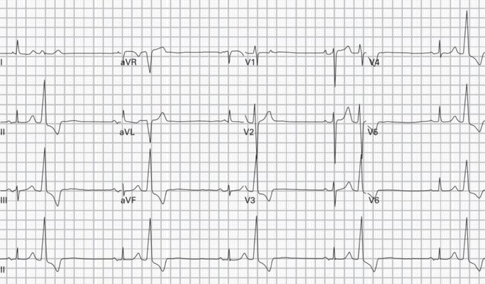 Diagnosis ?