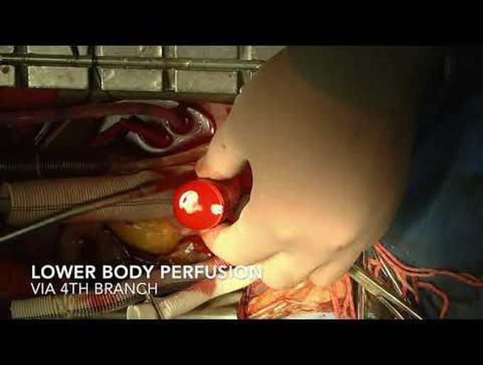Root and Total Arch Replacement and Frozen Elephant Trunk In Aortic Dissection: How We Do It