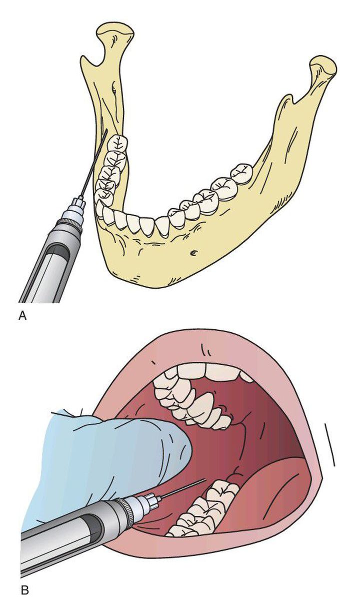 Long buccal nerve block