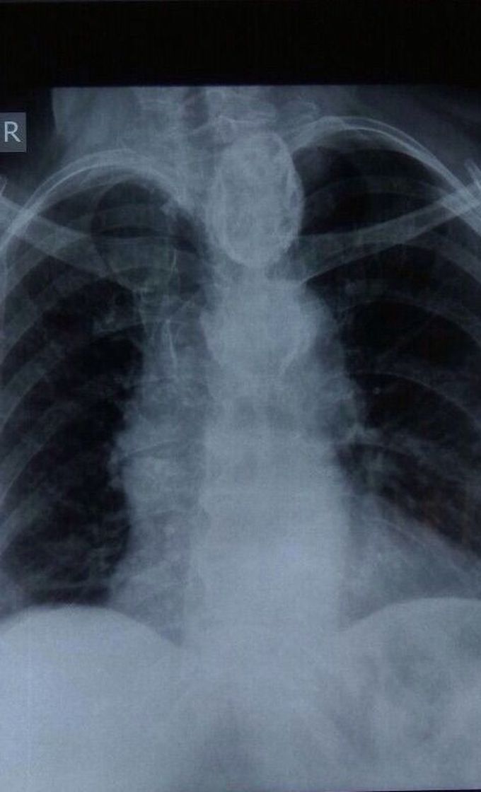 Retrosternal Thyroidism