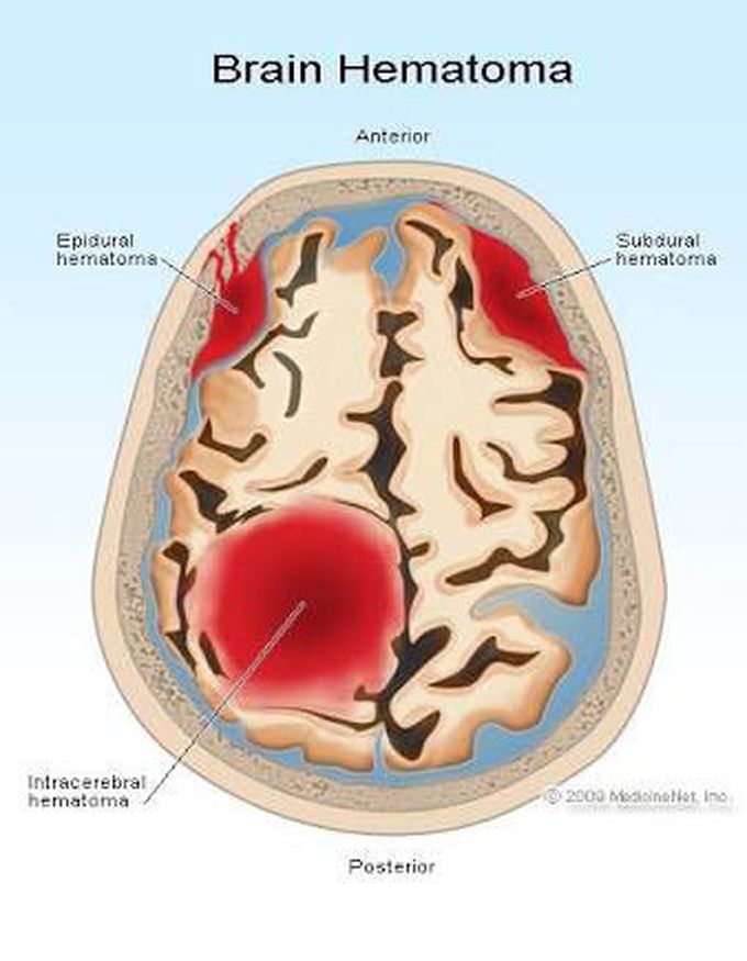 Brain Hematomas