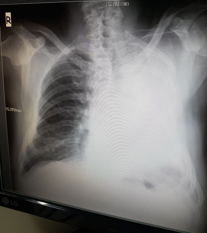 A patient without a left lung.