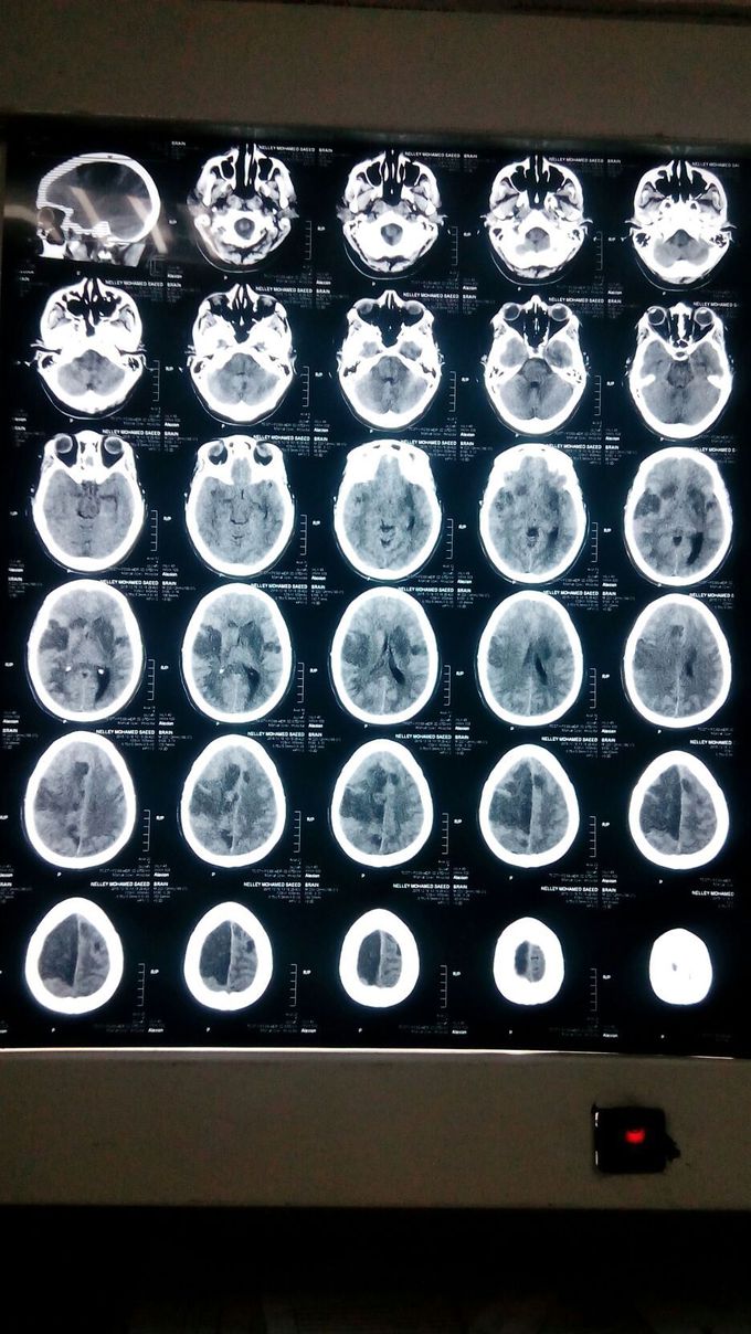 Massive brain infarction