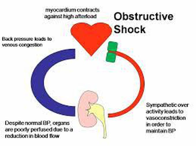 Causes of obstructive shock
