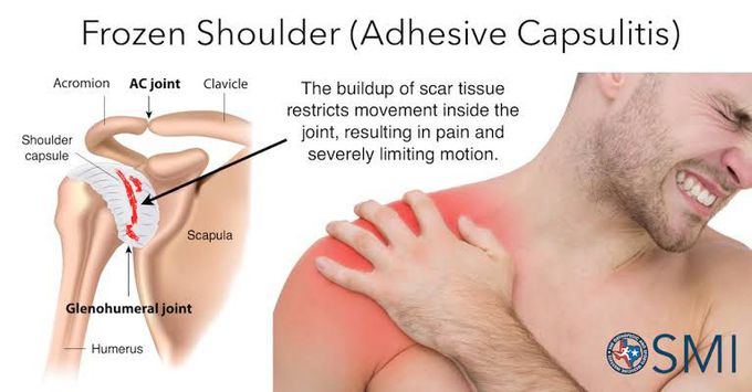 Adhesive Capsulitis- Manipulation