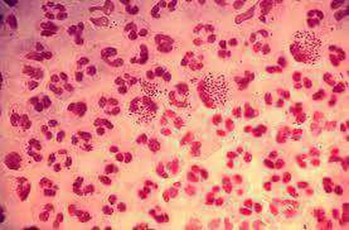 Infectious disease