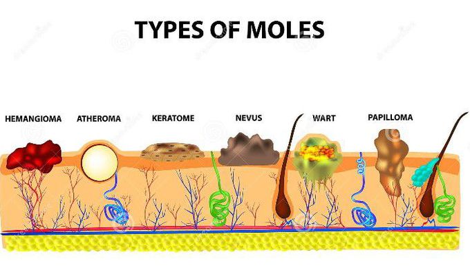 Types of  Moles