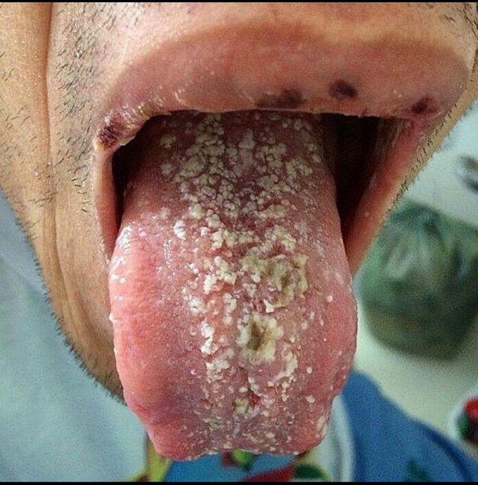 Oral Candidiasis