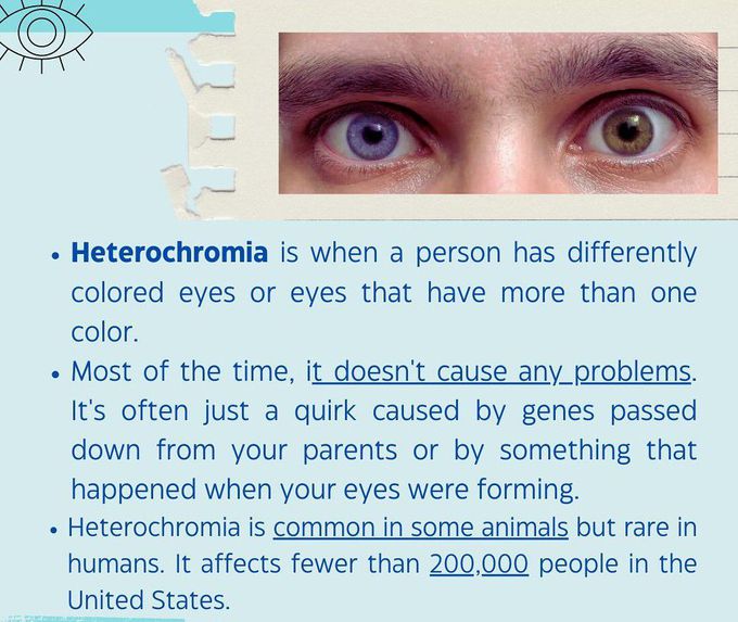 Heterochromia