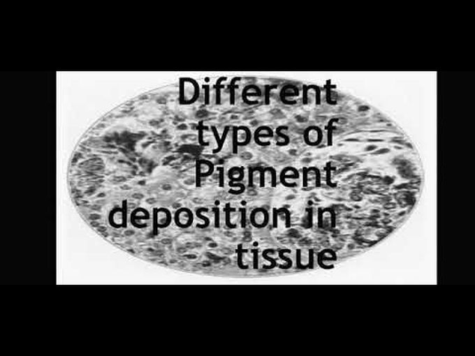Flashcard- Different pigment deposition in tissue