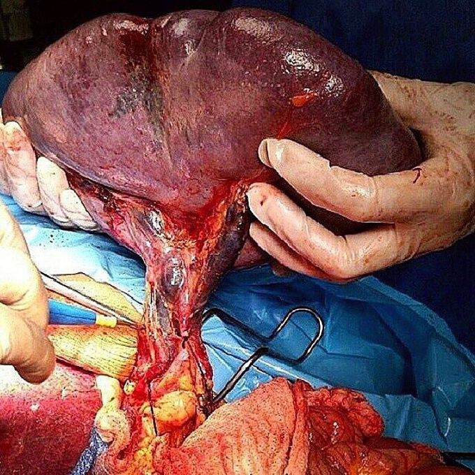 Splenectomy (surgical removal of the spleen) performed in a patient with a massive splenomegaly