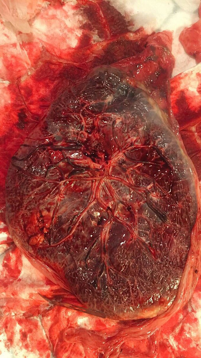 Placenta; The tree of Life