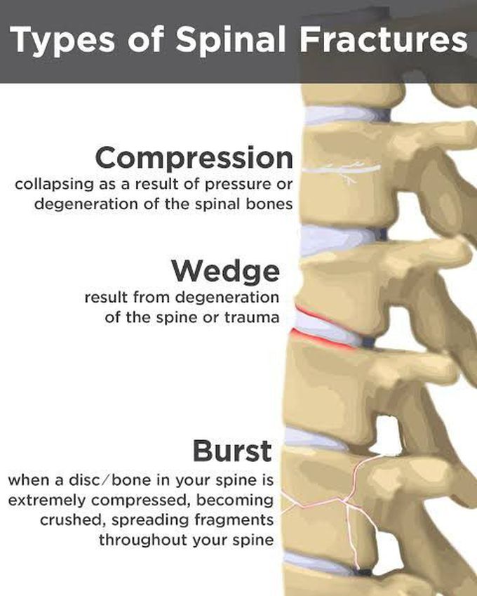 Types of spinal fracture