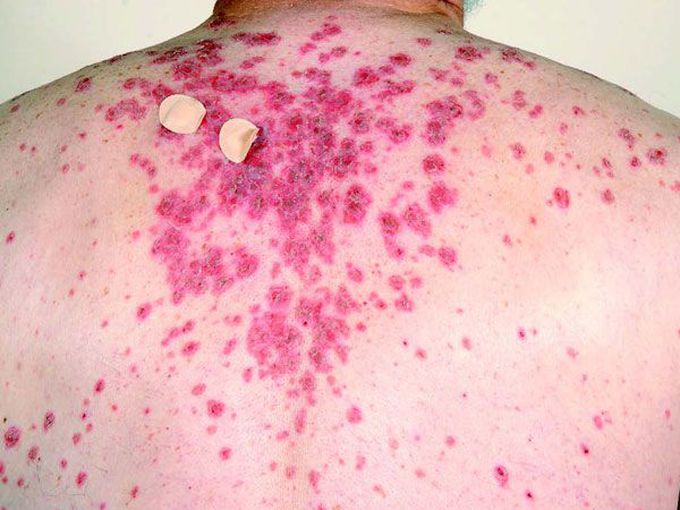 What is the most likely diagnosis?