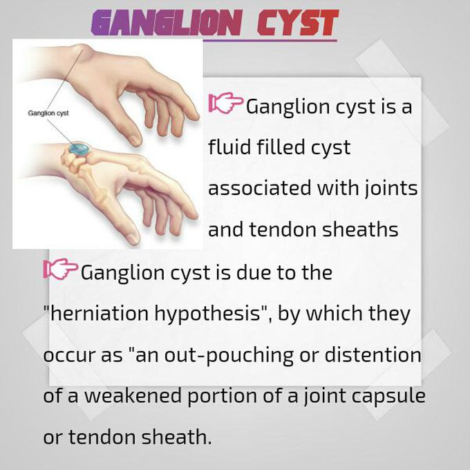 Ganglion cyst