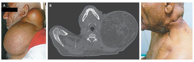 Hibernoma of the Neck